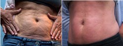loose skin, venu legacy, venus freeze, tummy tuck, myshape lipo, trevor schmidt pa-c, trevor schmidt
