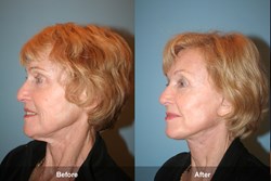 Dr. Kevin Sadati's Patient with Natural Facelift