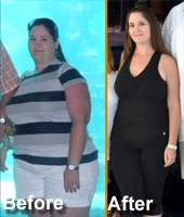 gastric bypass success story