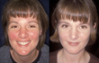 Rosacea Can Now Be Treated Faster With the All-new Revitol Rosacea...
