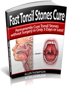 Fast Tonsil Stones Cure Review | Learn How To Cure Tonsilloliths ...