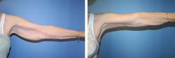 Before and After Armlift Plastic Surgery Dr. Kevin Sadati Gallery of Cosmetic Surgery Newport Beach California Orange County Facial Plastic Surgery