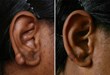 Keloid Treatment With CryoShape Is Now Available in Philadelphia and...