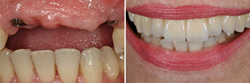 Teeth-In-A-Day