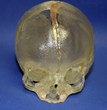 Surgeons Repair Congenital Craniofacial Skull Deformity in a...