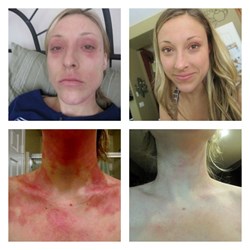 Allergic reaction induced by steroid therapy