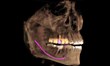 Dr. Ronald Receveur Offering the Only Galileos 3D CT Scan Imaging in...