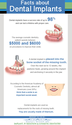Facts about dental implants.