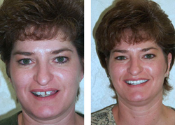 Dr. Ronald Receveur provides services including all on four dental implants, all on six dental implants, dental mini implants, full mouth dental implants, teeth in a day, teeth in an hour, IV sedation, and teeth whitening and other Aesthetic dentistry.