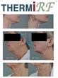 Study Demonstrates Single Treatment Skin Tightening Effect with...