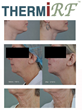 Study Demonstrates Single Treatment Tightening Effect With...