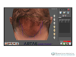 The ARTAS™ Hair Studio allows the physician to plan the aesthetic layout of recipient sites