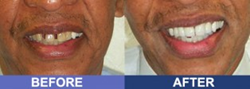 Dr. Ronald Receveur, provides services including all on four dental implants, all on six dental implants, dental mini implants, full mouth dental implants, teeth in a day, teeth in an hour, IV sedation, and teeth whitening and other Aesthetic dentistry.