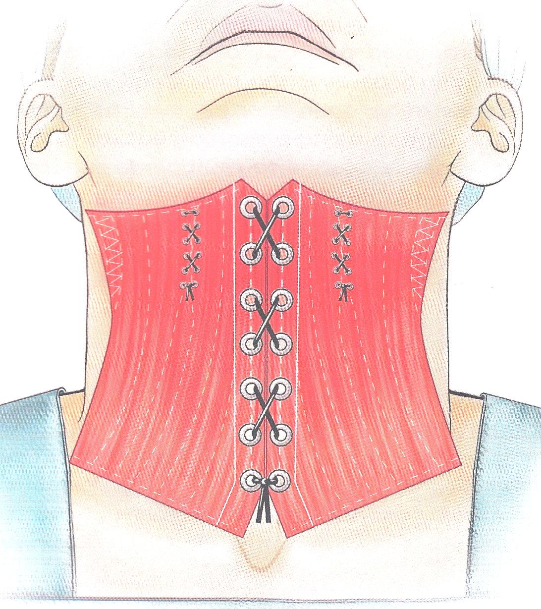 Chicago Cosmetic Surgeon Now Performs Less Invasive Corset Neck Lift