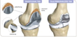 A New Personalized Solution to Knee Pain Comes to Mansfield...