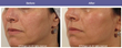 Pollogen Ltd. will Launch IMOGEN - a Recently FDA Cleared Anti-aging...