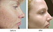 Kalologie Med Spa Offers Package Deal on IPL PhotoFacials