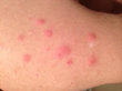 Bed Bugs Trouble Pitt County Elementary, My Cleaning Products Suggest...
