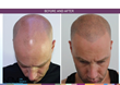 Color Me Today Debuts New Cosmetic Hair Loss Treatment in US