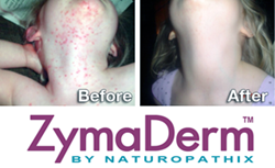 Young girl successfuly treated with ZymaDerm™