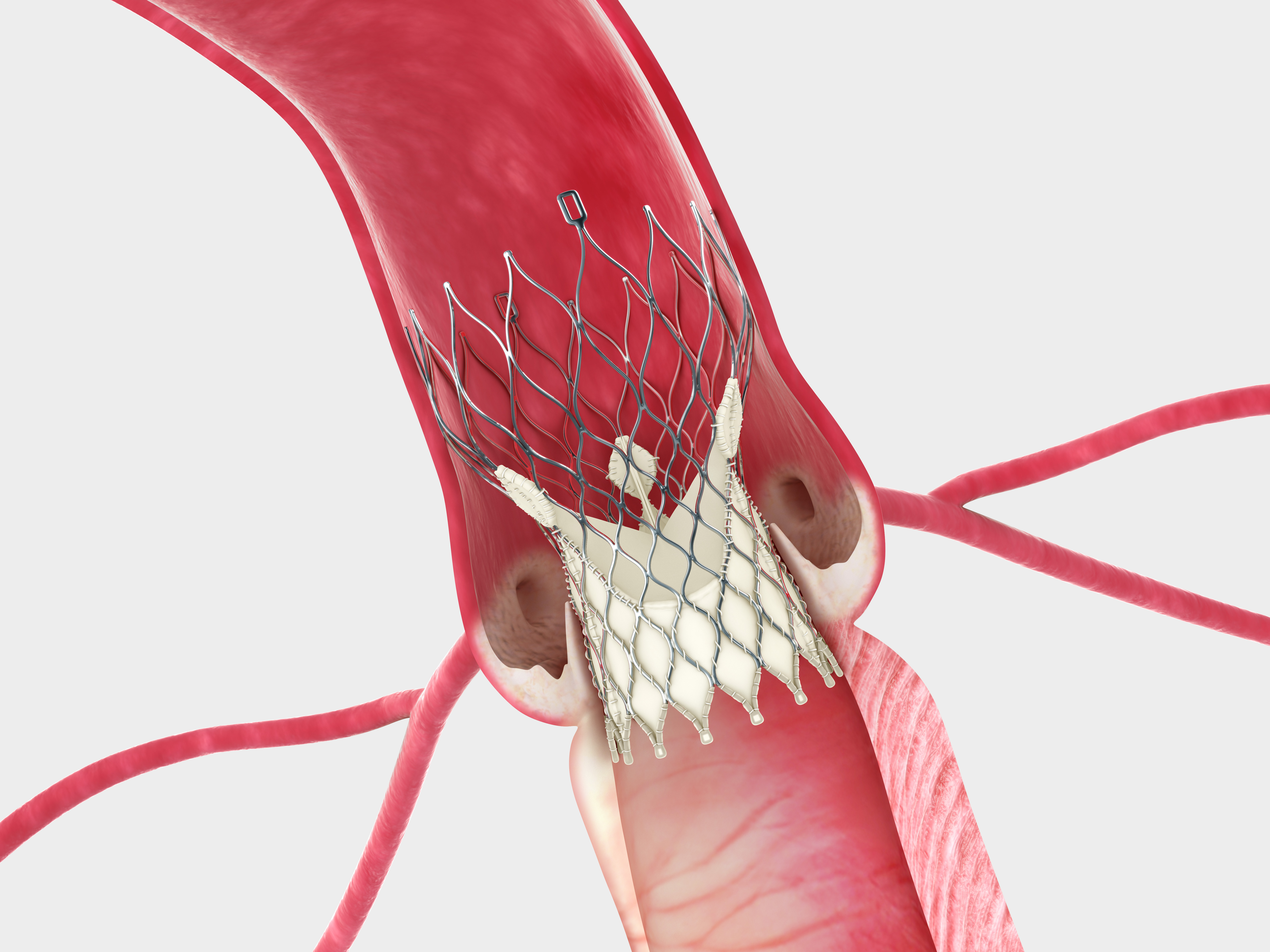 sanford-heart-hospitals-launch-newly-approved-device-to-replace-failing