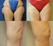 Lunch Break Lipo: Removes Unwanted Fat in Your Lunch Hour