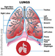 New Stem Cell Based Treatment for COPD; Nebulized Pure PRP System Uses...
