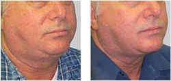 Exilis Chin and Neck