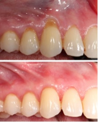Before & After Gum Recession Treatment