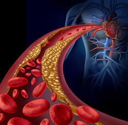 High cholesterol risks