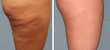Cellulite Doesn't Exist: Ending Dimply, Puckered Skin by...