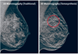 N J Breast Center Agrees 3D Mammography Is More Effective in Finding...