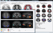 Syntermed's NeuroQ™ 3.7 for SPECT Brain Imaging to Be Previewed at SNMMI
