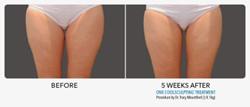 Coolsculpting Inner Thigh Gap Improvement