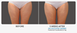 Using the Newly Approved Coolsculpting Handpieces, Dr. Steven Weiner...