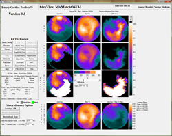 congestive heart failure