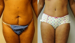 Lipoabdominoplasty