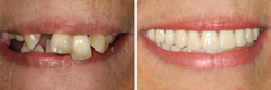 The revolutionary All-on-4™ dental implants procedure now makes it possible for patients to achieve the smile of their dreams in just one day.