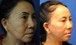 Shu Cosmetic Surgery of Twin Cities Now Offers More Choices in Facelift Services