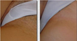 Laser Hair Removal in Brooklyn That’s Cheap and Effective is...