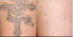 tattoo removal,laser tattoo removal,dark ink tattoo removal,non-surgical tattoo removal,fast tattoo removal