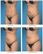 One of the Top Orange County Tummy Tuck Surgeons, Dr. Joseph T....