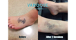 Undo That Tattoo With Vamoose Tattoo Removal