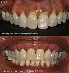 Before-After Chao Pinhole Gum Rejuvenation™