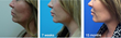 New Minimally Invasive Procedure, ThermiTight, “Injects” Radio...