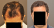 McGrath Medical Now Offers NeoGraft Automated FUE Hair Transplant