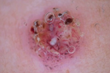 Adopting ‘Down Under’ Skin Cancer Initiatives Could Help with Surgeon...