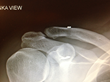 Study Results of a U.S. Patented AC Joint Separation Surgery over the...