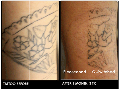 Colorado Welcomes World's Most Advanced Technology for Tattoo Removal