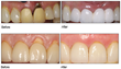 Dr. Alan M. Timko Offers The Chao Pinhole Surgical Technique™, a...